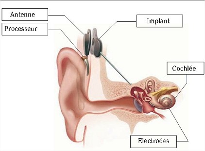implant cochléaire.jpg